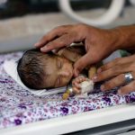 20 صورة تبين لك أن اليمن يعيش أكبر مأساة إنسانية في العالم التحالف