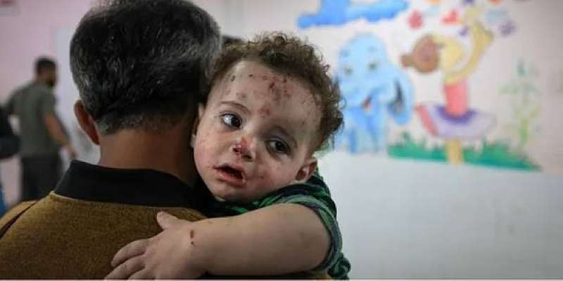 Smallpox In Kids Smallpox ravages the bodies of children in Gaza | الخبر اليمني